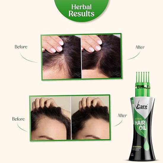వండర్ క్యాప్ తో కూడిన Vcare న్యూ ఇంప్రూవ్డ్ హెర్బల్ హెయిర్ ఆయిల్ - 100ml యొక్క చిత్రం